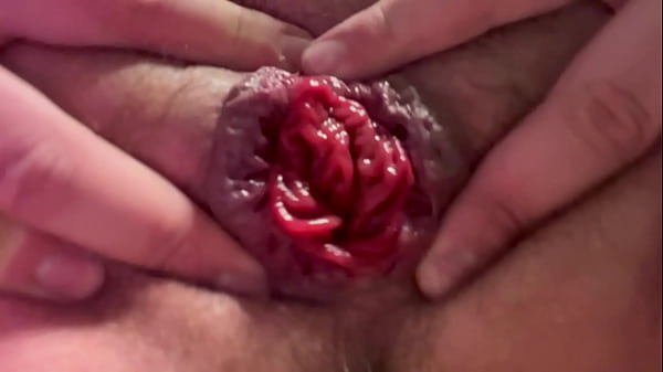 First anal prolapse