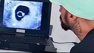Gynecologist performs ultrasound differently next to the horn!