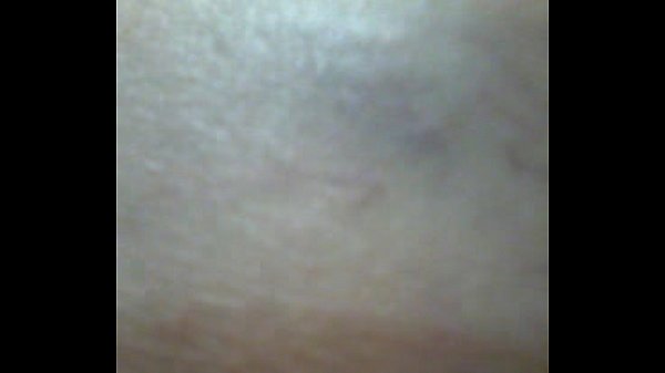 thumb cri