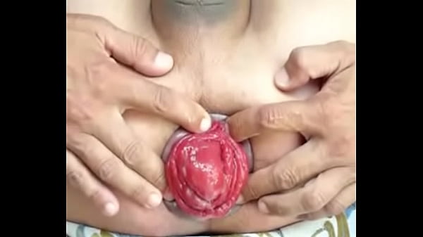 Prolapse in progress 160901sam815455