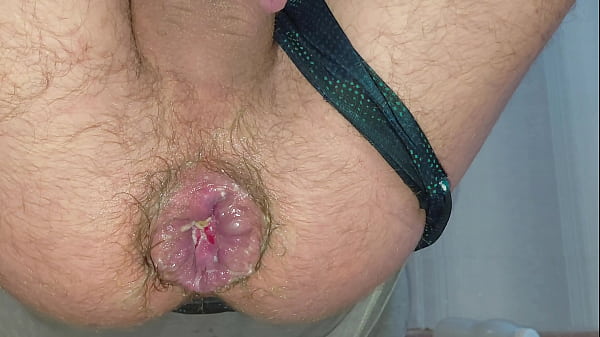 A stretched anus reveals a hemorrhoidal prolaps...