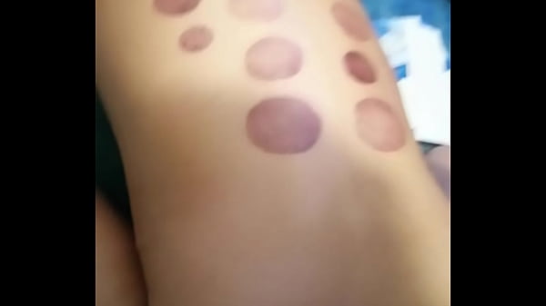 Vacumterapia