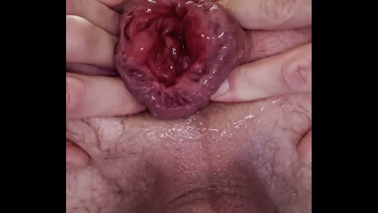 Anal rosebud and prolapse training part 2
