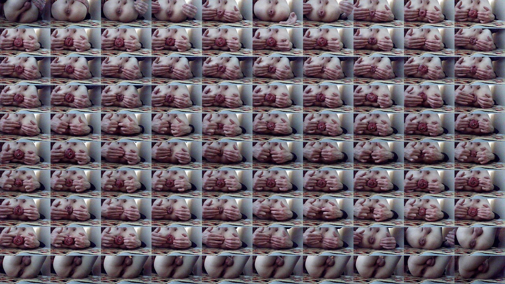 Anal prolapse 预览图