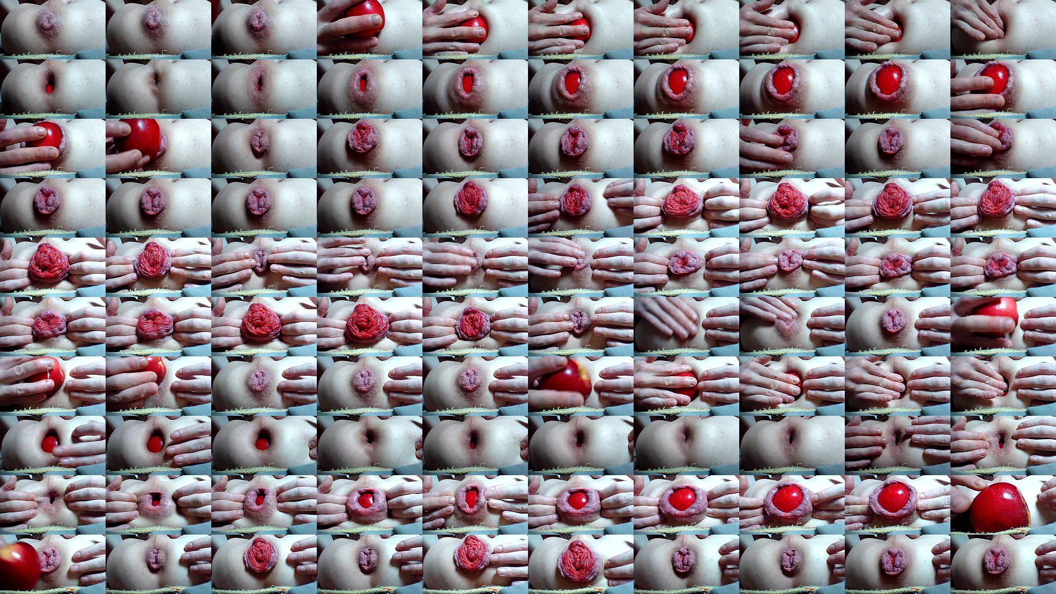 Anal prolapse 预览图