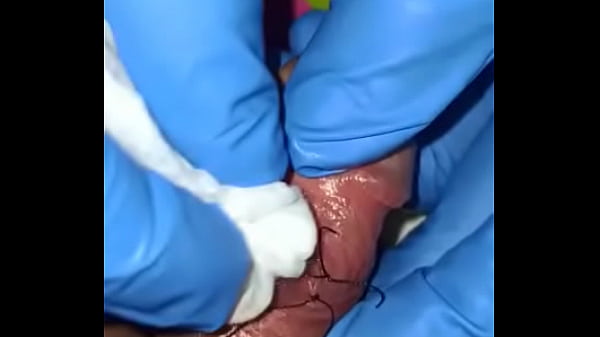 Perles Dans L'implantation Du Pénis