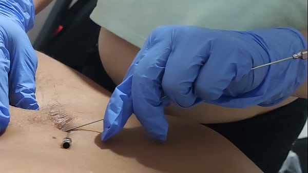 Aiguille Dans L'abdomen